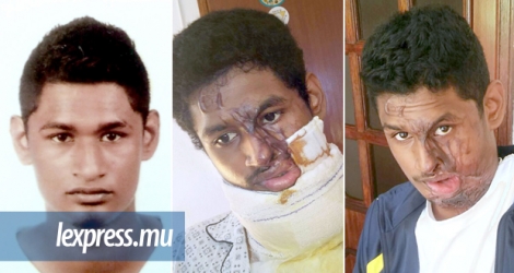 Venkatesh Camdoo avant son agression, durant son séjour à l’hôpital et aujourd’hui. Ces images, dures, montrent la gravité des conséquences d’une attaque à l’acide. (photos publiées avec l’autorisation de la victime et des parents)
