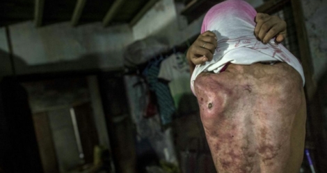 L'adolescente Khin Khin Tun montre les cicatrices sur son dos, le 13 février 2017 à Mawlamyine, en Birmanie