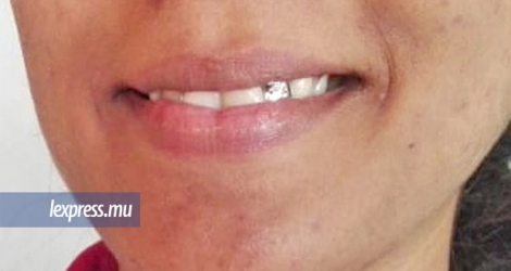Au milieu des molaires et des canines bien alignées: une dent en platine. 