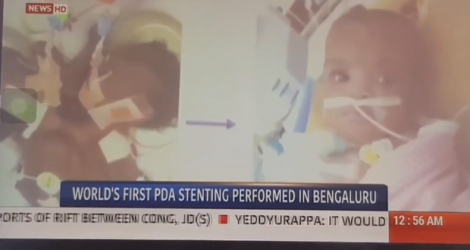 La télévision indienne parle du cas de Cléanne Papillon, «3e bébé miracle» à avoir survécu à une telle séparation de siamois.