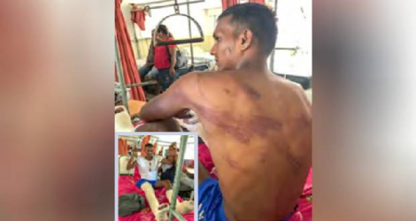 Après son arrestation, Krishna Seetul s’est retrouvé avec les deux jambes fracturées. Son corps était recouvert de traces causées par des coups.
