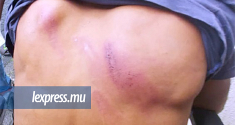 Des proches de Rivano Pitchen estiment qu’il ne s’est pas blessé en tombant mais qu’il a reçu des coups de matraque.