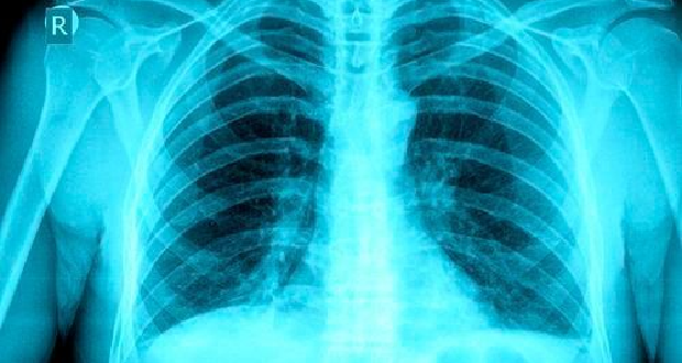Covid-19: la radiographie pour «sauver des vies» ?