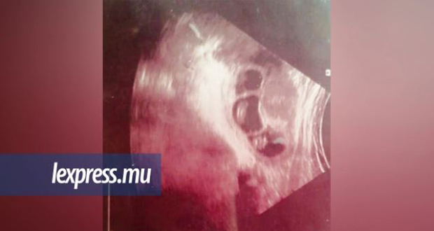Hôpital de Rose-Belle: pas de négligence concernant la mort des triplés du couple Antoine