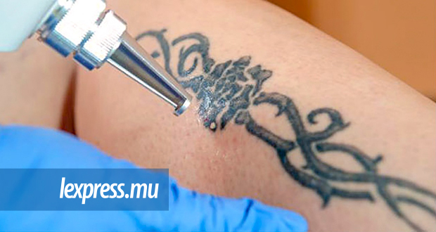 Enlèvement des tatouages au laser: traitement coûteux, chronophage et pas fait pour tout le monde