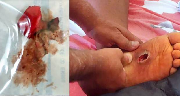 Négligence médicale alléguée: un enfant de 11 ans vit avec un morceau de savate coincé dans les pieds…