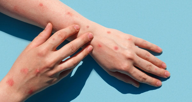 Premier cas de Mpox confirmé à Maurice : mesures immédiates mises en place